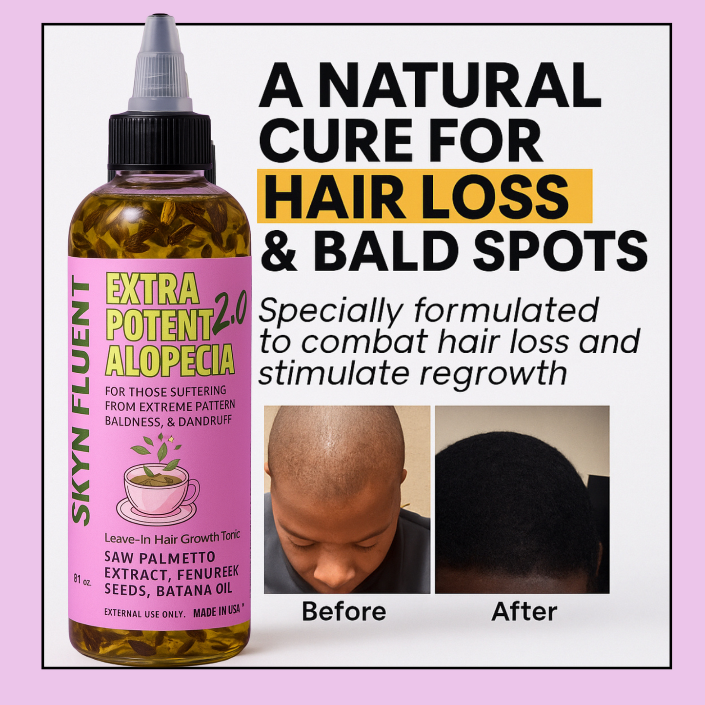 Alopecia Hair Growth Tonic – For Thinning Edges & Bald Spots