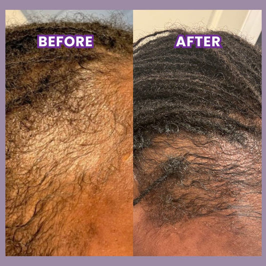 Alopecia Hair Growth Tonic – For Thinning Edges & Bald Spots